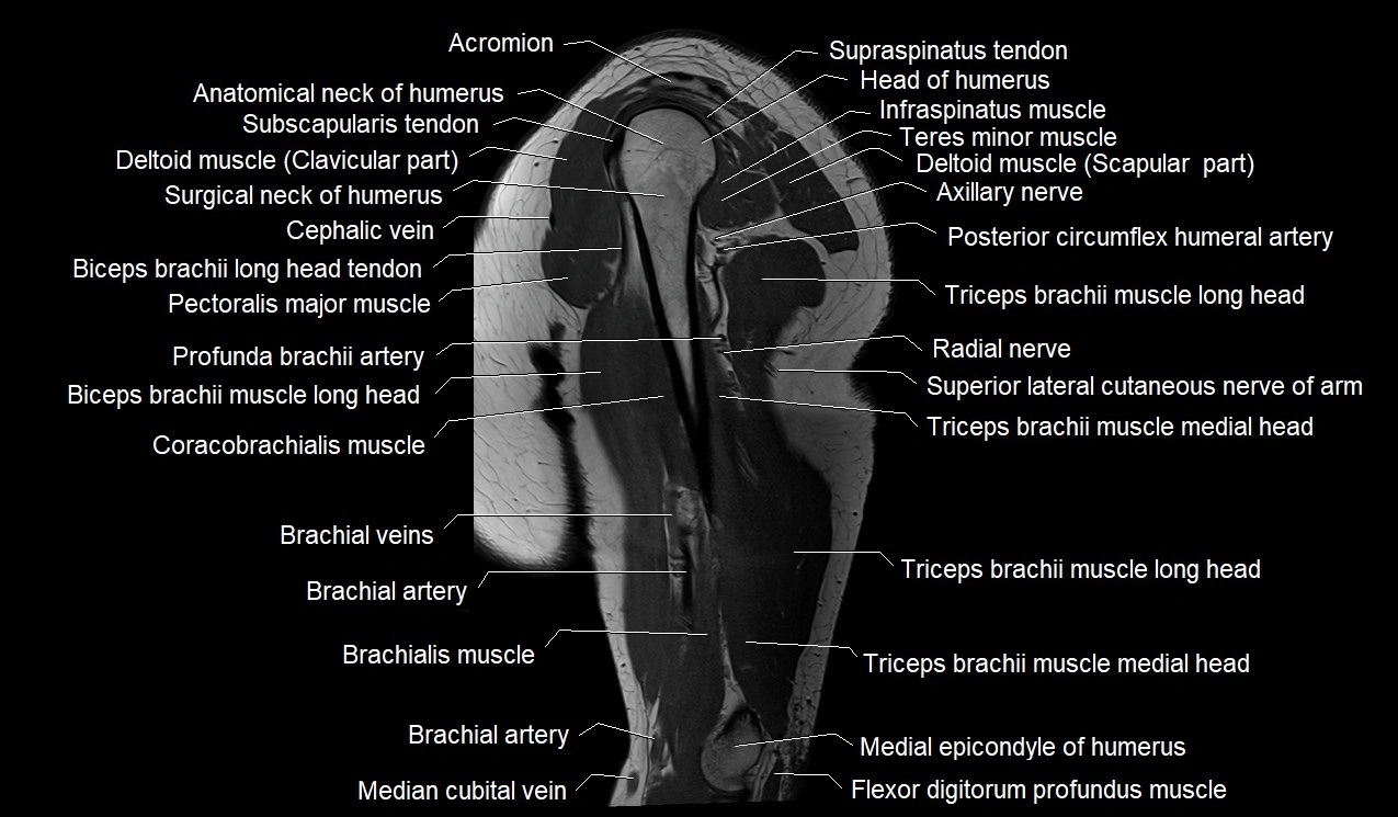 Upper arm (humerus ) saittal cross sectional anatomy 3T image 19.webp